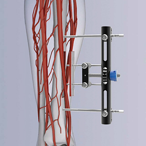 Sistema de Transporte Óseo Transverso de Tibia (TTT)